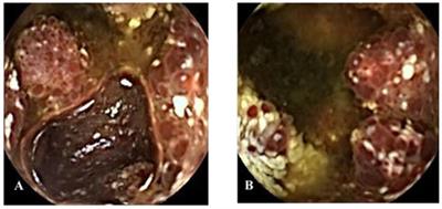 Case Report: Endoscopic manifestations and clinical features of small intestinal lymphangioma—A report of two cases